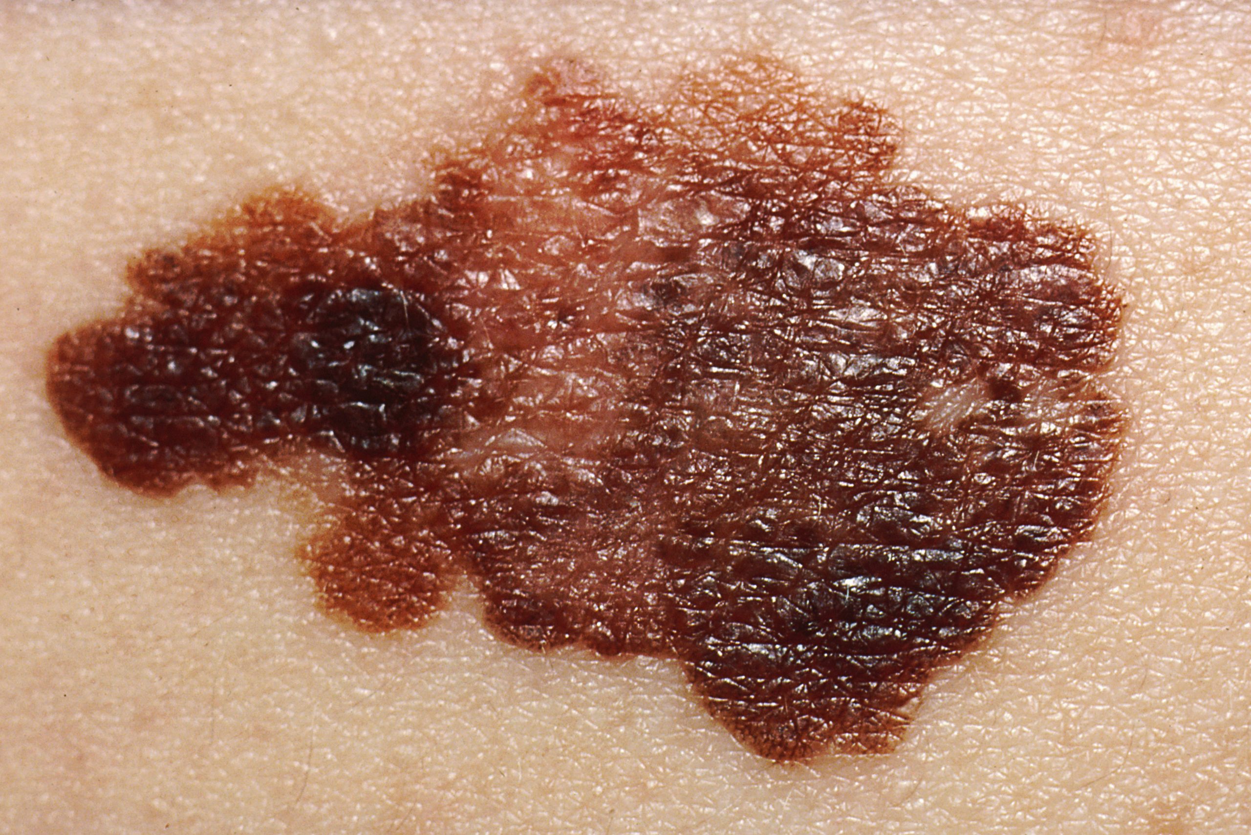 Melanoma Wellness Tips: Age-Related Fibroblast Changes and Treatment Solutions