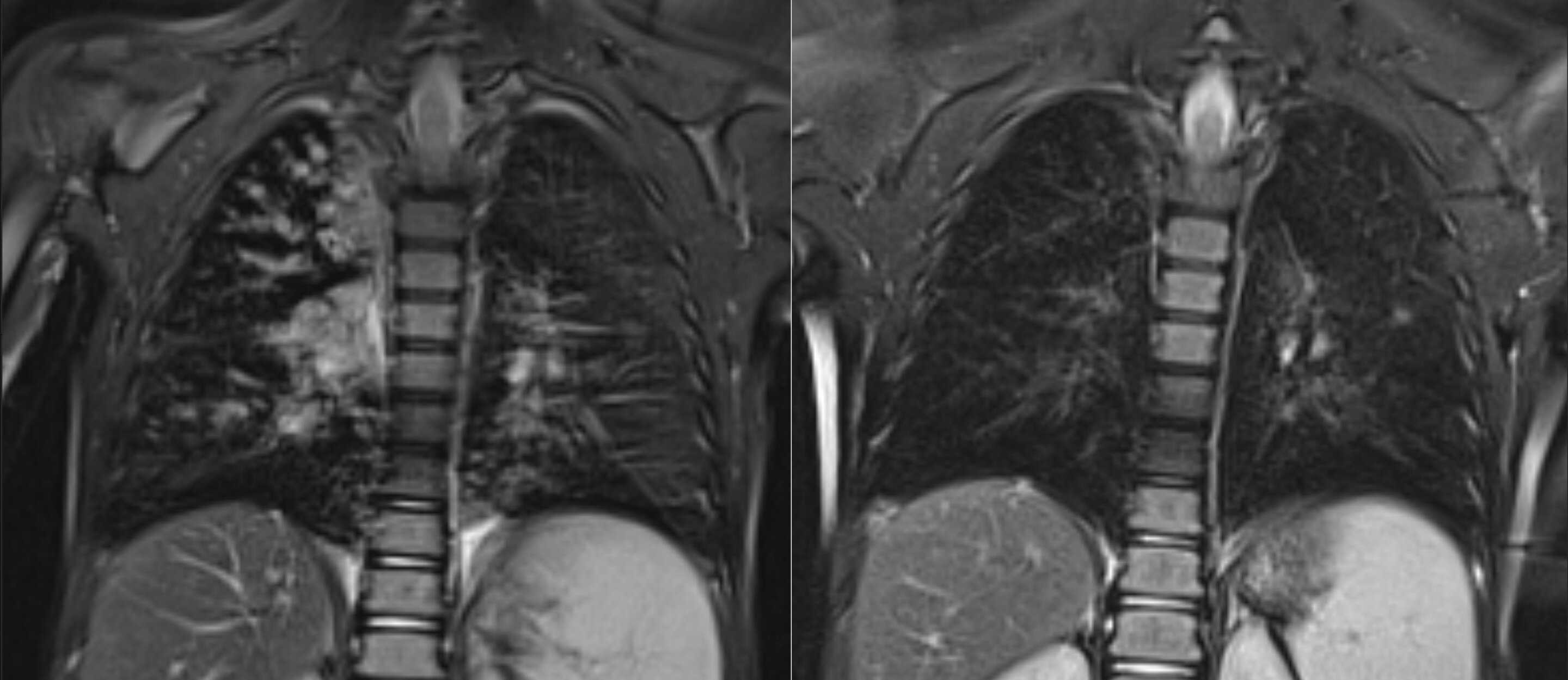 Discover the Healthy Solution: Triple Combination Therapy for Cystic Fibrosis Patients