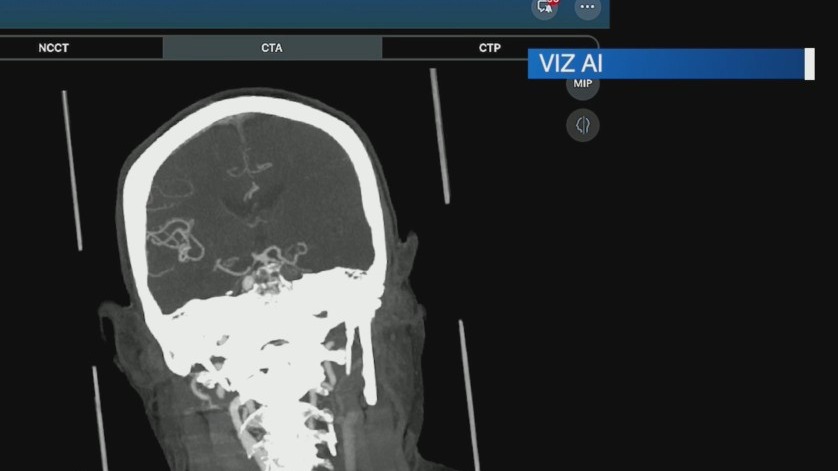 TGH Implements AI Tech to Enhance Stroke Care Outcomes