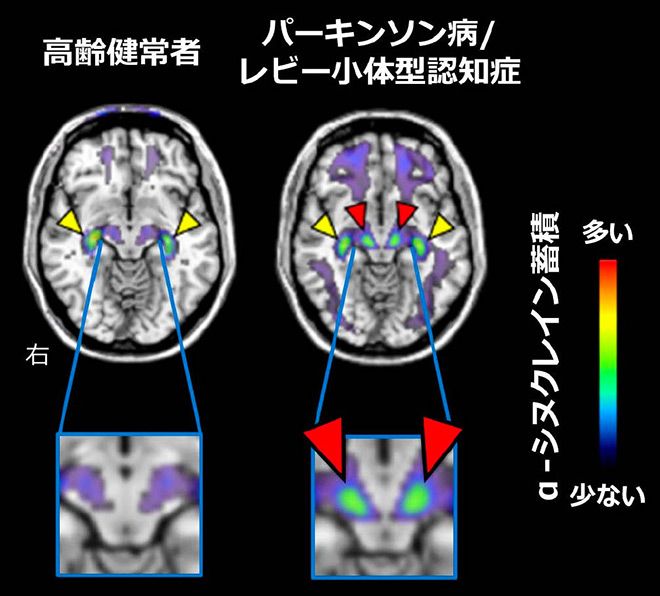 Unlock the Cure: Novel Tracer Detects Alpha-synuclein in Parkinson's Disease and Dementia with Lewy bodies