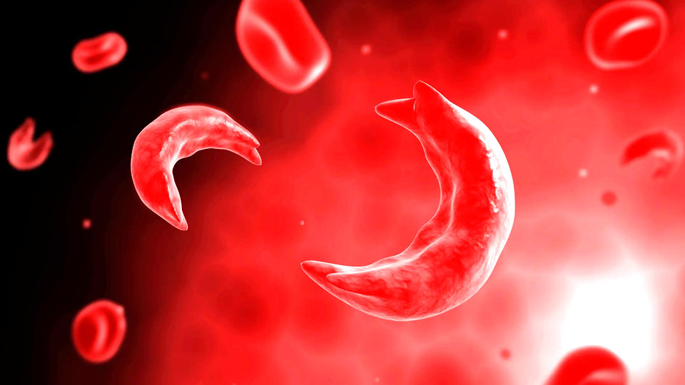 Discover Wellness Tips for Managing Sickle Cell Disease