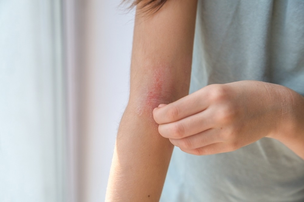 Adverse Events Prevention: Healthy Tips for Atopic Dermatitis Corticosteroid Use