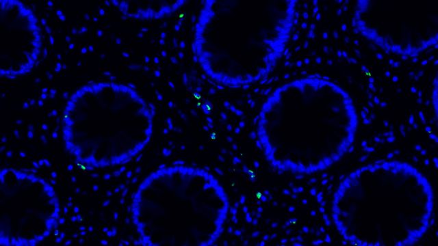 Discover the Solution for Long COVID: Abnormal Immune Cell Activation and Viral Persistence