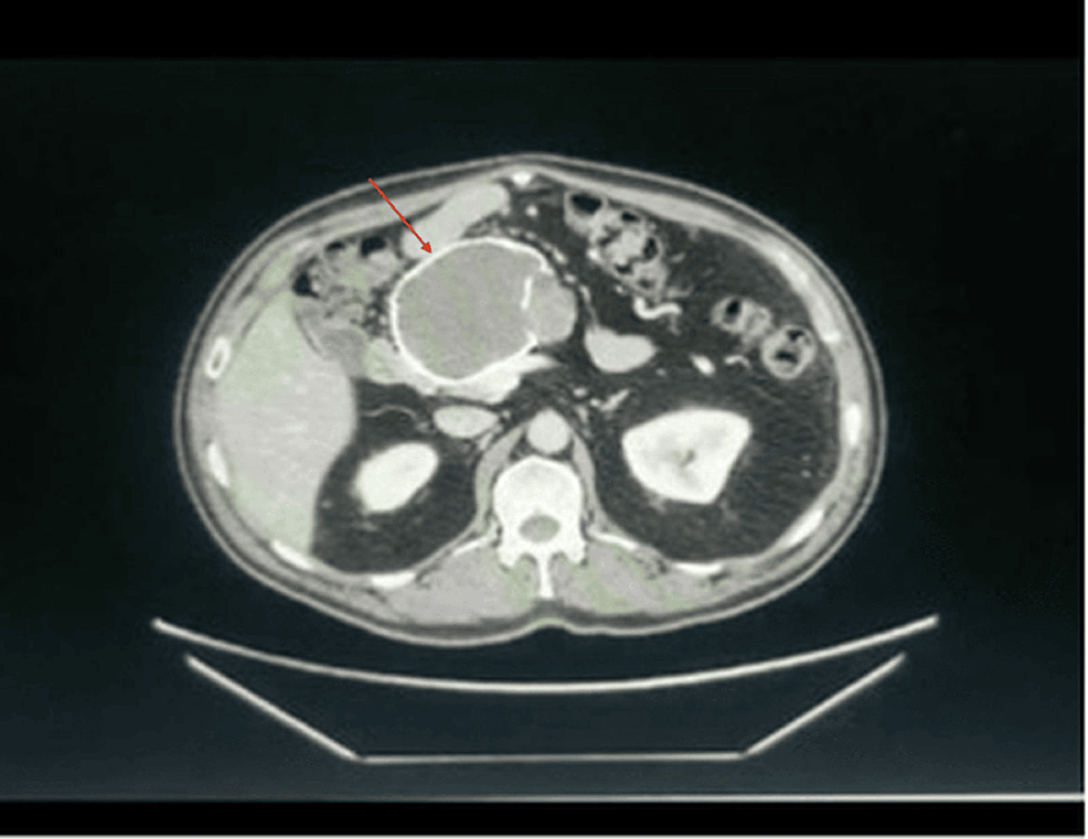 Discover the Solution: Solid Pseudopapillary Tumour Literature Review