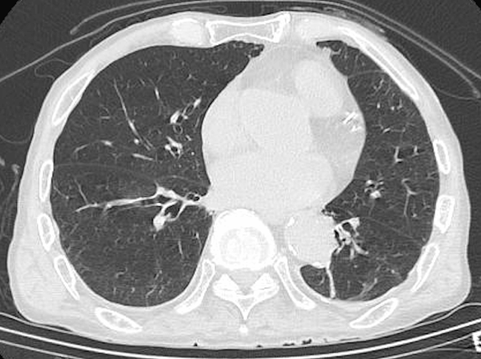 Predicting Acute Intestinal Ischemia Cases in the Era of COVID-19: A Comprehensive Analysis and Management Strategies