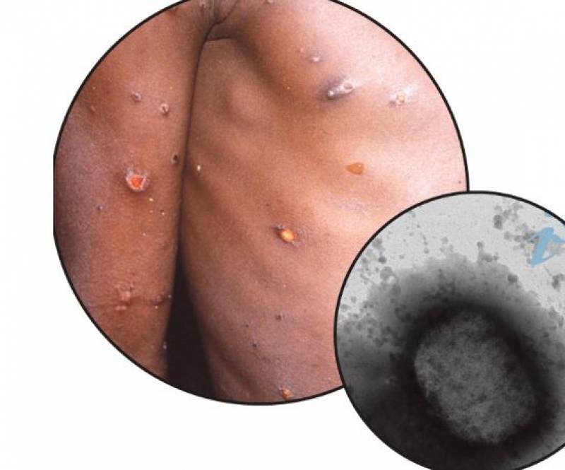 Mpox Solution: Tips to Combat the Outbreak in Spain