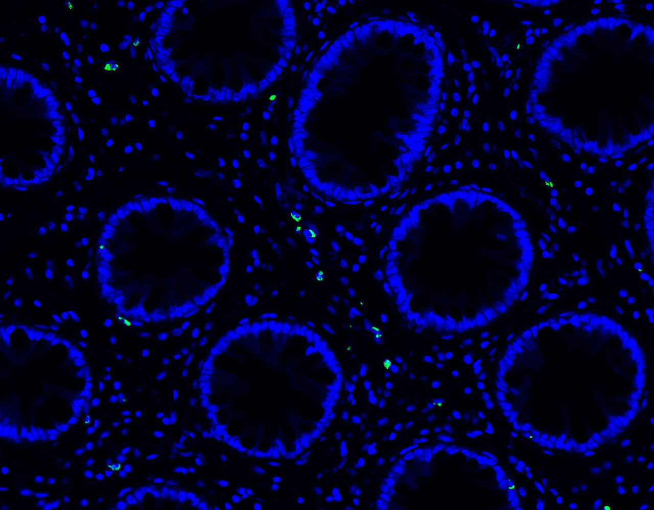 Discover the Solution for Long COVID: Abnormal Immune Cell Activation and Viral Persistence