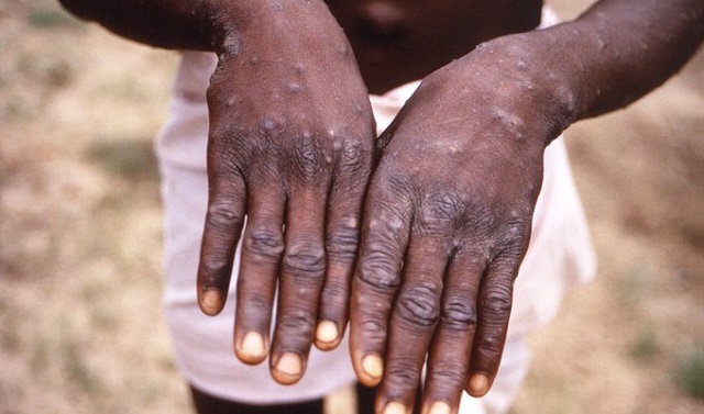 Mpox Solutions: Russian Aid for Public Health Emergency