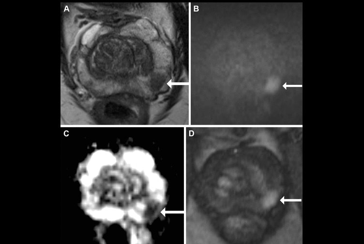 Discover the Effective Tips for Detecting Aggressive Prostate Cancer Subtypes with MRI