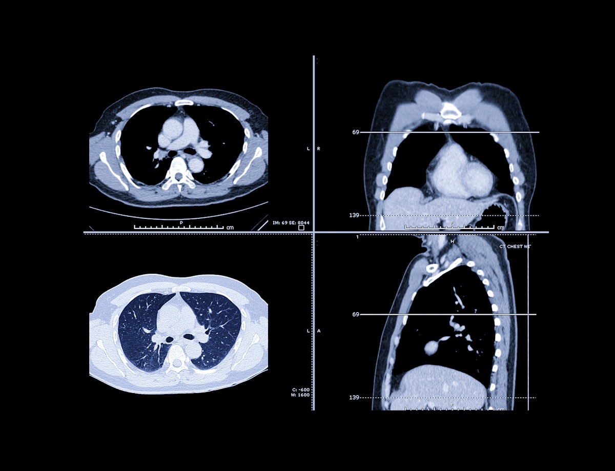 Healthcare Solutions: Tips for Interstitial Lung Disease Imaging