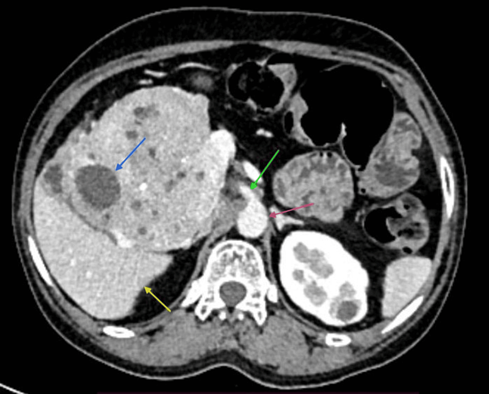 Discover the Solution: Solid Pseudopapillary Tumour Literature Review