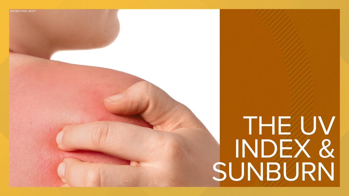 Ultimate Sunburn Prevention Tips for Healthy Skin