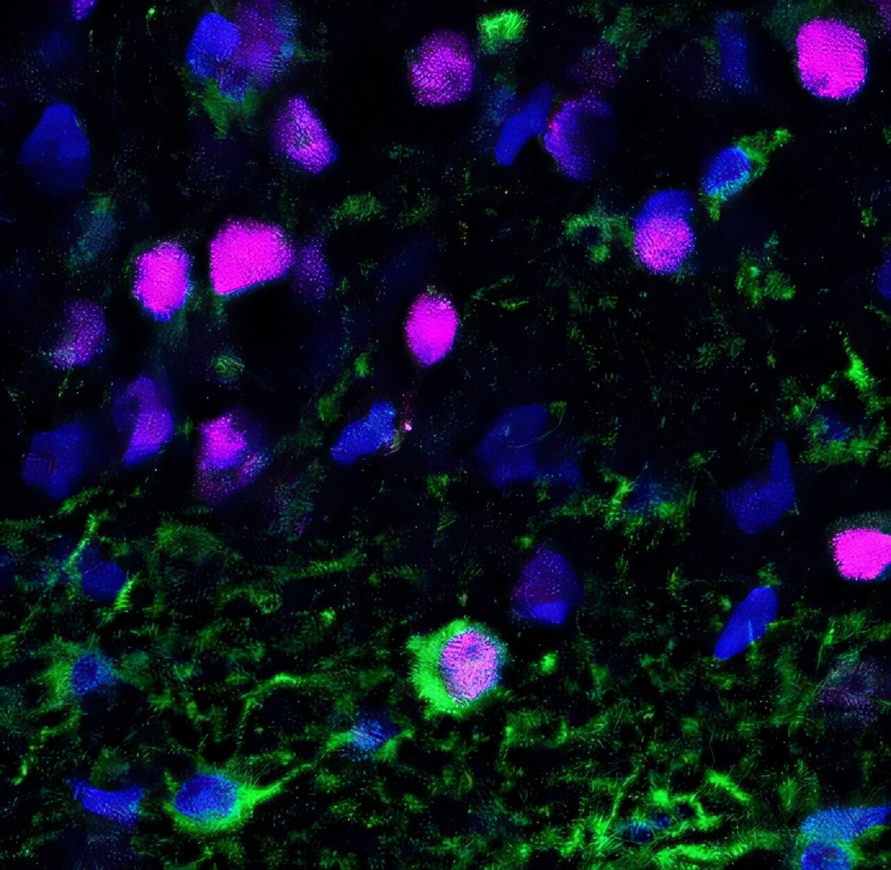 Neurogenesis Tips: Enhance Verbal Learning and Memory in MTLE Patients