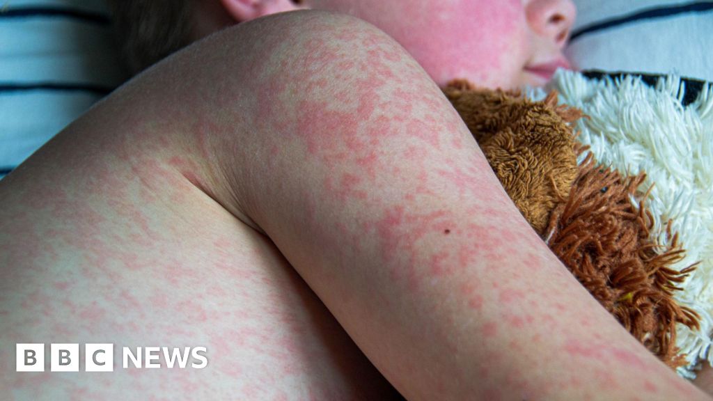 Get Instant Protection: Measles Vaccination Tips for Healthy Living