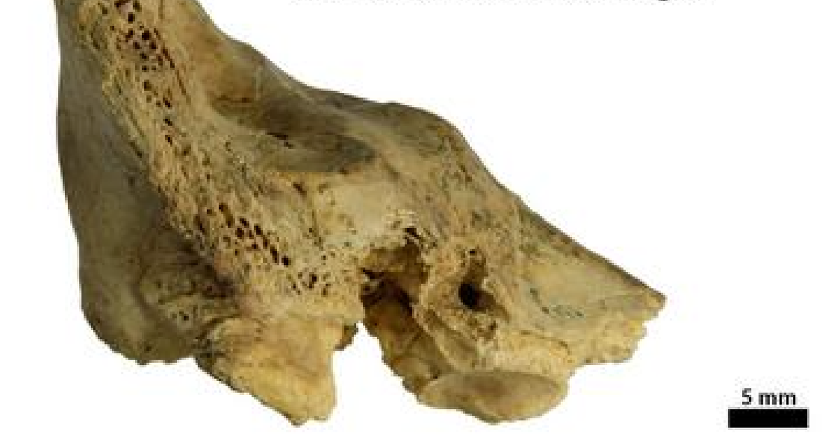 Compassionate Neanderthal Care: Insights from Down Syndrome Fossil