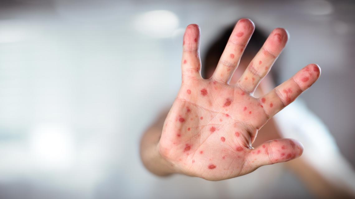 Tips to Prevent Measles Outbreak: Vaccinate for Wellness