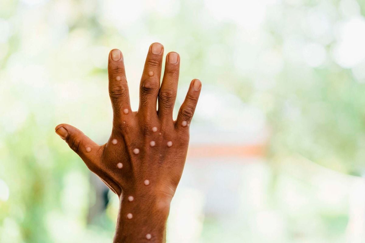 Mpox Prevention Tips for Healthy Living