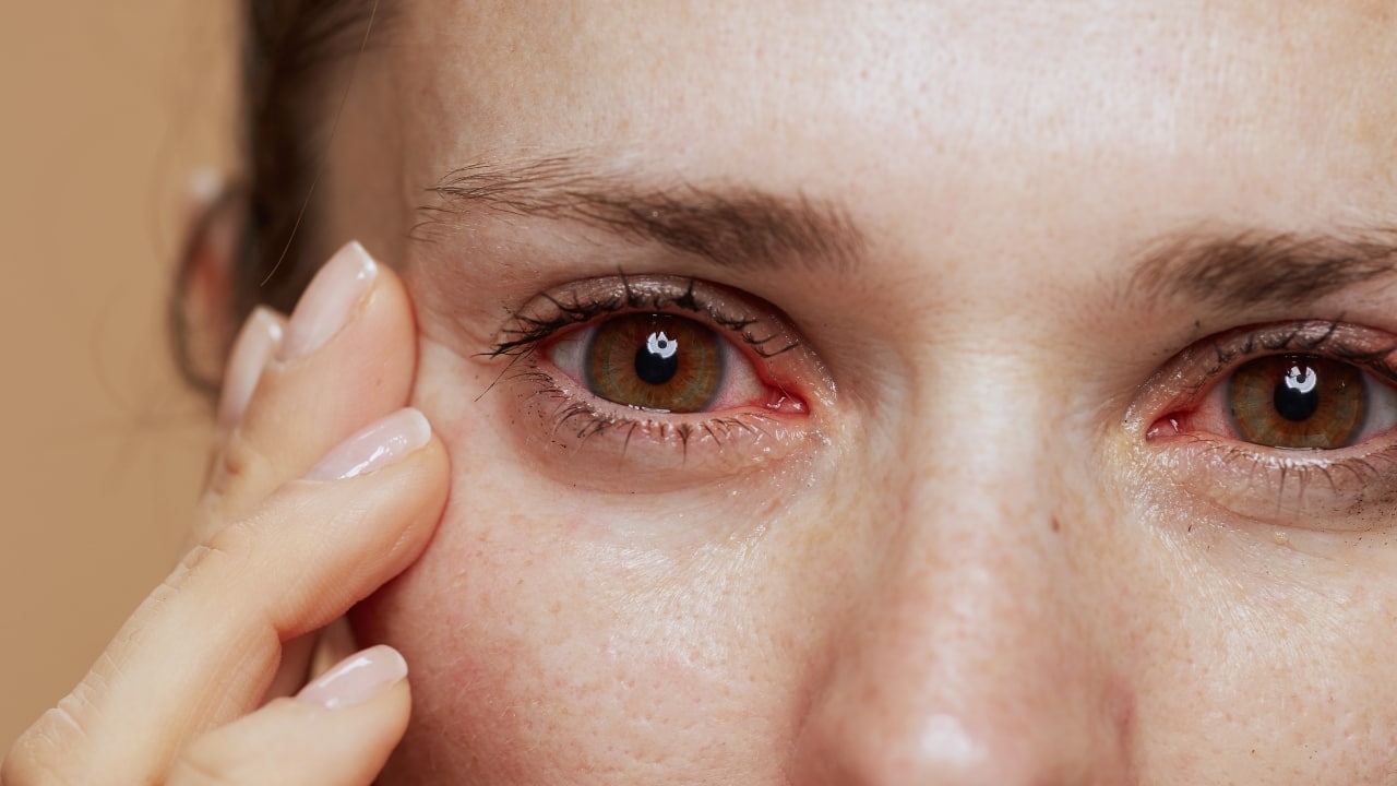 Discover Healthy Solutions for Dry Eye Syndrome: Tips for Instant Relief