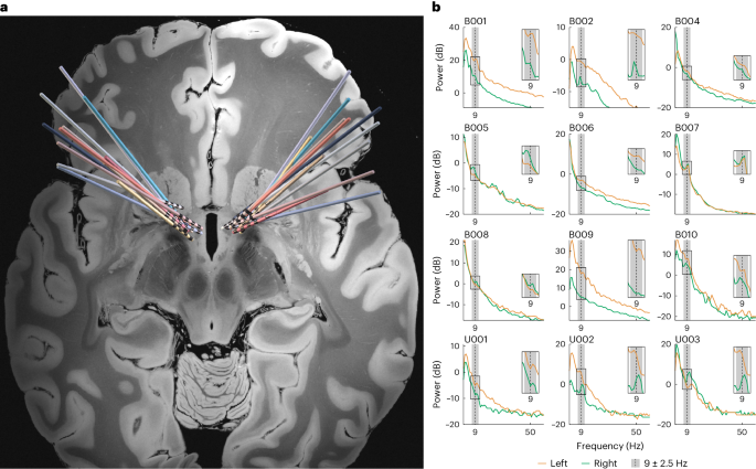 Revolutionizing Treatment for Obsessive–Compulsive Disorder with Deep Brain Stimulation Tips