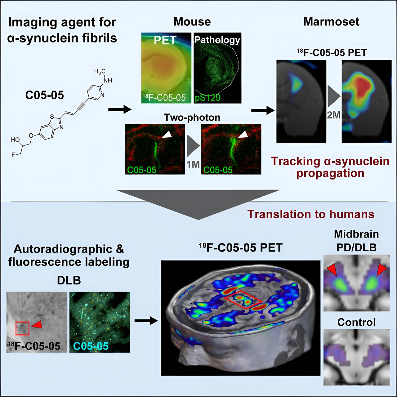 Unlock the Cure: Novel Tracer Detects Alpha-synuclein in Parkinson's Disease and Dementia with Lewy bodies