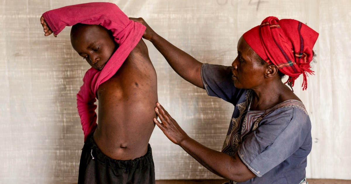 Mpox Outbreak in Africa: Tips for Healthy Prevention