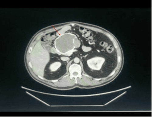 Discover the Solution: Solid Pseudopapillary Tumour Literature Review