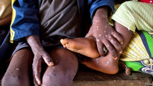 Discover Healthy Tips to Combat Mpox Outbreak in Democratic Republic of Congo