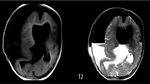 Discover the Tragic Case of Fetus in Skull: Young Girl in China Passes Away