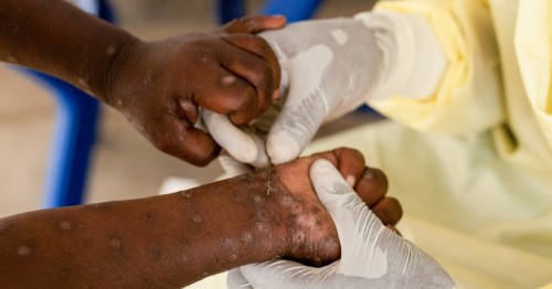 Mpox Monitoring in China: Tips for Global Health Security