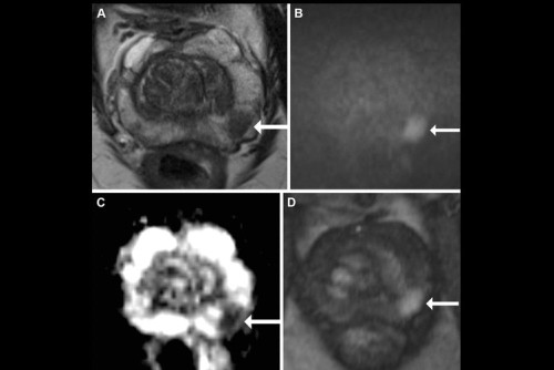 Discover the Effective Tips for Detecting Aggressive Prostate Cancer Subtypes with MRI