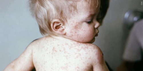 Prevent Measles: Tips for Healthy Living