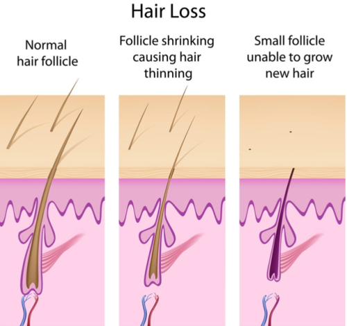 Unlock the Future of Hair Restoration: Advancements in Hair Transplantation Techniques