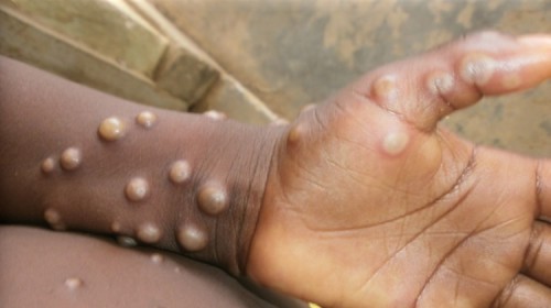 Mpox Wellness Tips: Protect Yourself from the Virus