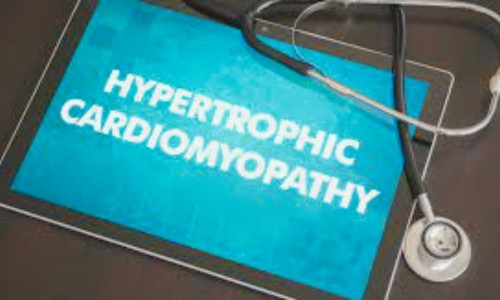 Gadolinium Solution: Tips for Predicting Sudden Cardiac Death in Young Patients with Hypertrophic Cardiomyopathy