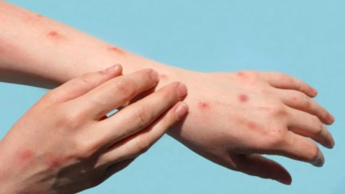 Mpox Virus Management: Essential Tips for Treatment and Prevention