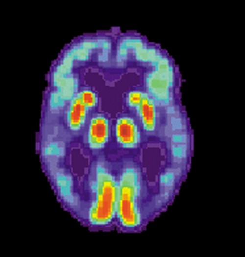 Discover the Healthy Solution for AL Amyloidosis: Antibody Tips